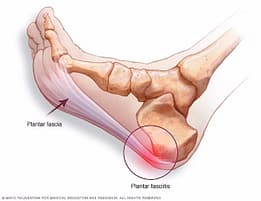 Medical illustration of a foot showing plantar fasciitis with inflammation at the heel