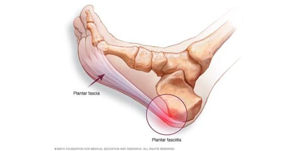 Medical illustration of the foot showing the plantar fascia ligament along the sole and highlighting inflammation near the heel, indicating plantar fasciitis.